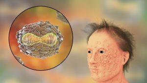 Primeiro infectado com varíola dos macacos recebe alta em SP