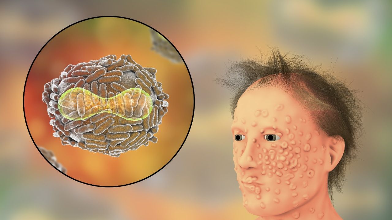 Primeiro infectado com varíola dos macacos recebe alta em SP