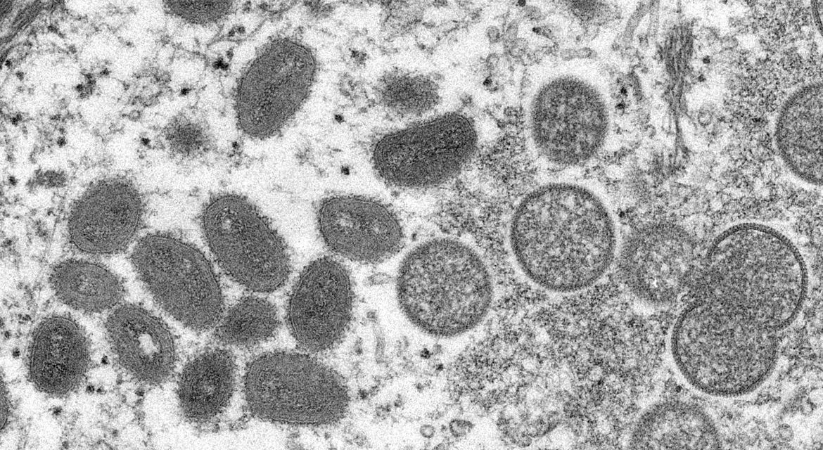 Goiânia tem dois casos confirmados de varíola dos macacos, diz Saúde