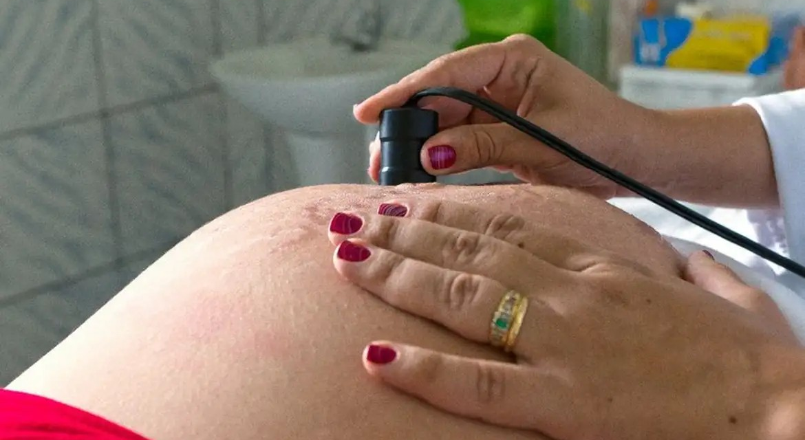 Saúde recomenda cálcio para todas as gestantes para prevenir eclâmpsia