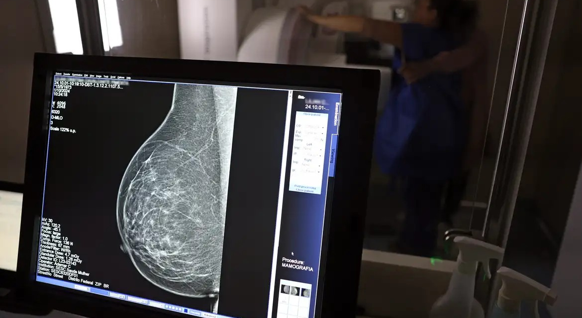 Falta de acesso a mamógrafos limita prevenção do câncer de mama