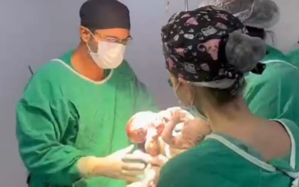 Gêmeos siameses do Mato Grosso nascem em Goiânia Gêmeos siameses do Mato Grosso nascem em Goiânia