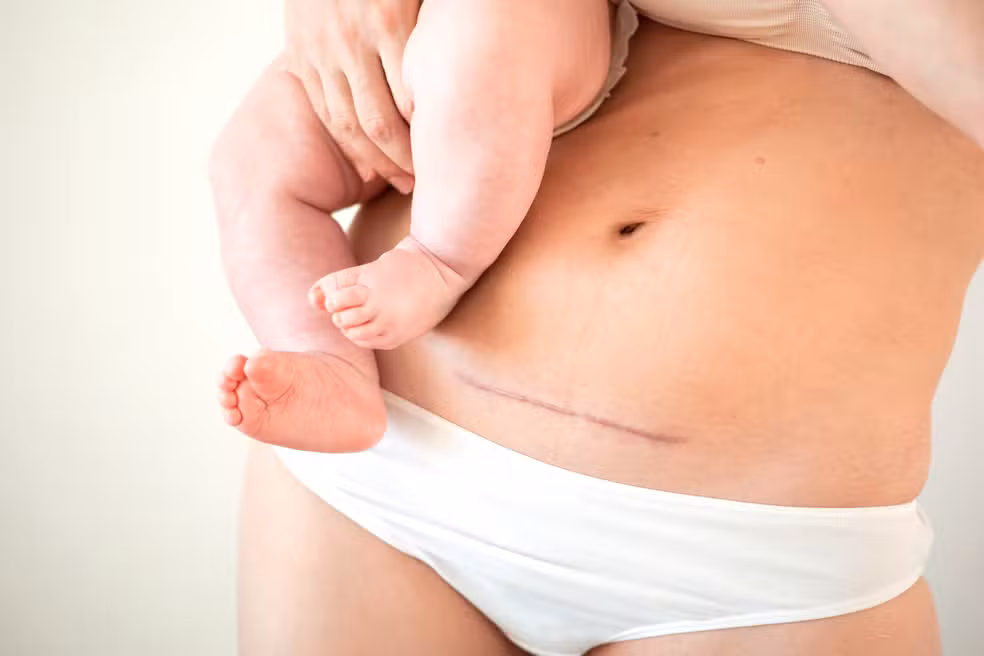 Estudo do UNICEF explica por que muitas gestantes trocam o parto normal pela cesariana